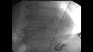 Placing a left ventricular lead over the wire into the coronary vein [upl. by Millham]