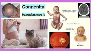 congenital toxoplasmosis [upl. by Stanfill]