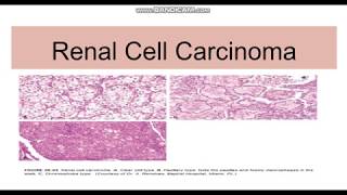 Renal cell carcinoma TypesGeneticsMorphology [upl. by Cordova]