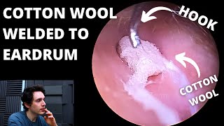 Cotton Wool Welded To Eardrums Why Dont We Numb Up Patients [upl. by Jamal]