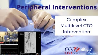 Complex Multilevel CTO Intervention [upl. by Driscoll]