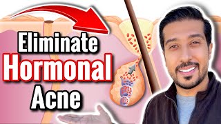 How to Get RID of Hormonal Acne  5 Ways to Treat Hormonal Acne [upl. by Stockton]