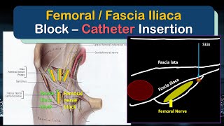 Femoral Nerve  Fascia Iliaca Block Catheter  A quotHowToquot Guide to Insertion [upl. by Noral776]