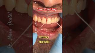 Gingivitis Gum Bleeding [upl. by Marybella504]