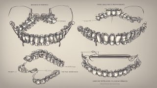 Types of Braces Which One is Right for You  Discover your options and find the perfect fit [upl. by Kwapong792]