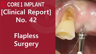 CYBERMED Clinical Report 24 25 Flapless implant placement [upl. by Eanil171]