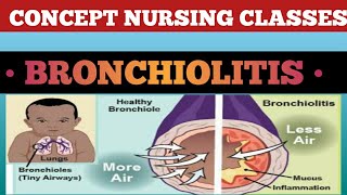 Bronchiolitis causesign symptoms treatment and prevention [upl. by Sperling]