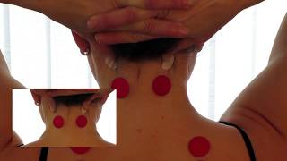 How to Stop Headaches and Migraines Instantly The 1 Minute Effects with Pressure Points [upl. by Eillil]