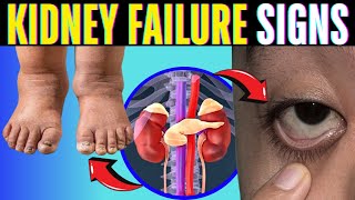 Kidney Failure Symptoms 10 Signs Most People Ignore [upl. by Lonier]