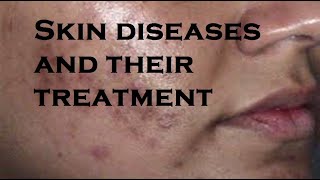 Skin diseases and their treatment [upl. by Kauslick]