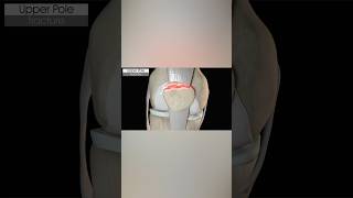 Upper Pole Patella Fracture medicalanimation health [upl. by Celle]