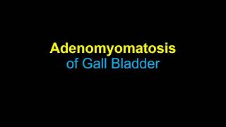 Gall Bladder Adenomyomatosis on Ultrasound [upl. by Niarbo]