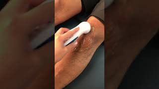 Ultrasonido en bursitis de rodilla [upl. by Marillin]