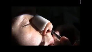 Columellar suture removal day 4 after Rhinoplasty [upl. by Candie400]