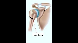 Fisioterapia quotFractura de Humeroquot [upl. by Luca714]