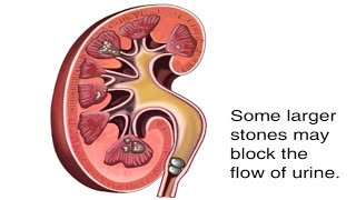 How Kidney Stones Are Formed Animation  Renal Calculi Causes amp Symptoms Video  Blocked Urine Flow [upl. by Cirad]