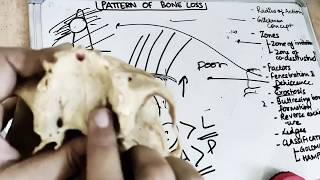 pattern of bone loss in periodontal disease [upl. by Ihana]