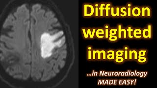 Diffusion Weighted Imaging DWI in Neuroradiology made easy [upl. by Kotta]