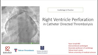 Right ventricle perforation in catheter directed thrombolysis CDT of pulmonary artery [upl. by Nesyrb367]