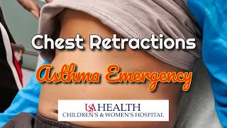 Chest Retractions in a Severe Asthma Attack [upl. by Hailat300]