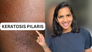 keratosis pilaris  keratosis pilaris causes  Keratosis pilaris treatment hindi [upl. by Toolis]