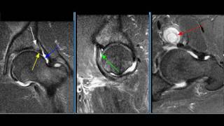 MRI Hip Case 11 [upl. by Lorin947]