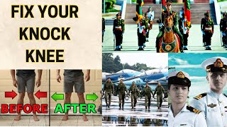 Knock Knee Correction for Military Candidates  A Guide for Army Navy and Air Force Applicants [upl. by Marnie]