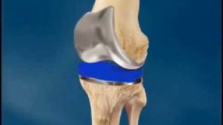 Total Knee Replacement Surgery Arthroplasty  University of Vermont Medical Center Vermont [upl. by Initirb]