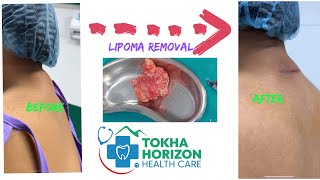 lipoma removal of nape of neck  dr bijay  tokha horizon [upl. by Laehplar]