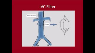 Management of DVTPulmonary Embolus [upl. by Ruenhcs]