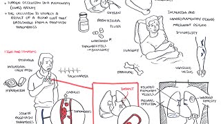 Pulmonary Embolism  Overview [upl. by Florinda233]