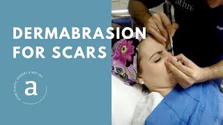 Dermabrasion for Scars  Live Demo by Dr Athre [upl. by Nyvlem664]