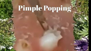 Popping Pimples and Blackheads  3 [upl. by Hilbert887]