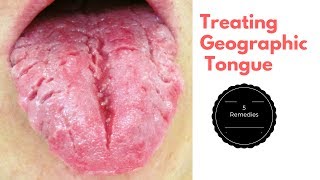 Top 5 Home Remedies for Treating Geographic Tongue [upl. by Rabin]