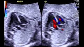 Tetralogy of Fallot 5 chamber view with colour [upl. by Nima]