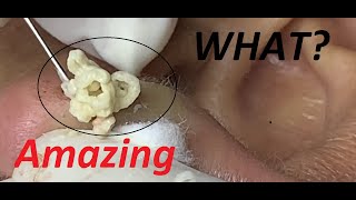 26  BIG CYST on the ears BLACKHEADS and WHITEHEADS for uncle [upl. by Herrera427]