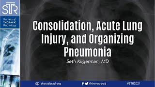 HRCT Consolidation Acute Lung Injury and Organizing Pneumonia [upl. by Acinimod]