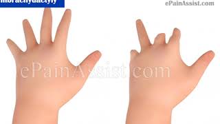 congenital ✋ hand difference ✋Treatment options [upl. by Ingvar]