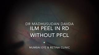 ILM peel in Retinal Detachment no PFCL [upl. by Euqinue136]