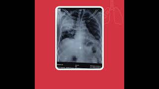 A Case of Right Lobar Pneumonia with Septic Shock advancedtechnology healthcarefacility [upl. by Assinna]