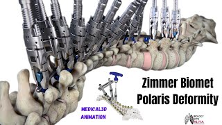 Zimmer Biomet  Polaris Deformity  Medical 3D Animation  BiologywithAliya [upl. by Junno282]