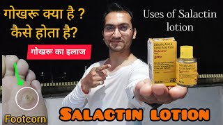 Foot corn गोखरू क्या है कैसे होता है एवं इसे ठीक कैसे करेंUses of Salactin lotion gokhru [upl. by Lleoj]