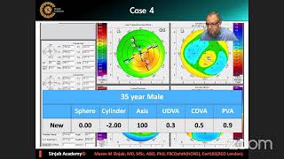 Corena  To The Wonderland  Keratoconus Decision Making  Mazen Sinjab [upl. by Garibull549]