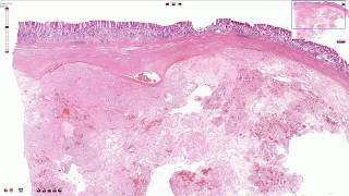 Gastrointestinal Stromal Tumor GIST  Histopathology [upl. by Severson]