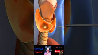 Goiter and thyroid tumor animation anatomy [upl. by Cave]