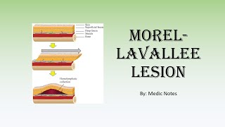 Morellavallee lesion  causes signs and symptoms investigation treatment [upl. by Claribel]