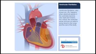 Ventricular Fibrillation Animation Video [upl. by Aicel493]