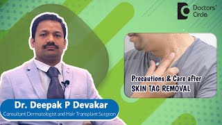 SKIN CARE After LASER SKIN TAG REMOVAL  Radiofrequency Laser  Dr Deepak P DevakarDoctors Circle [upl. by Laro311]