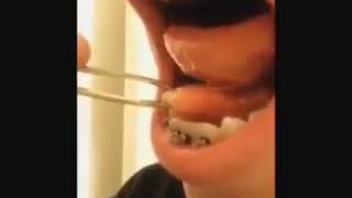 Sialolithiasis—Salivary duct stone removal [upl. by Aitnis457]