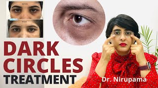 Dark circles Dark circles treatment Undereye dark circles cream  Dark circle home remedies [upl. by Jamel130]